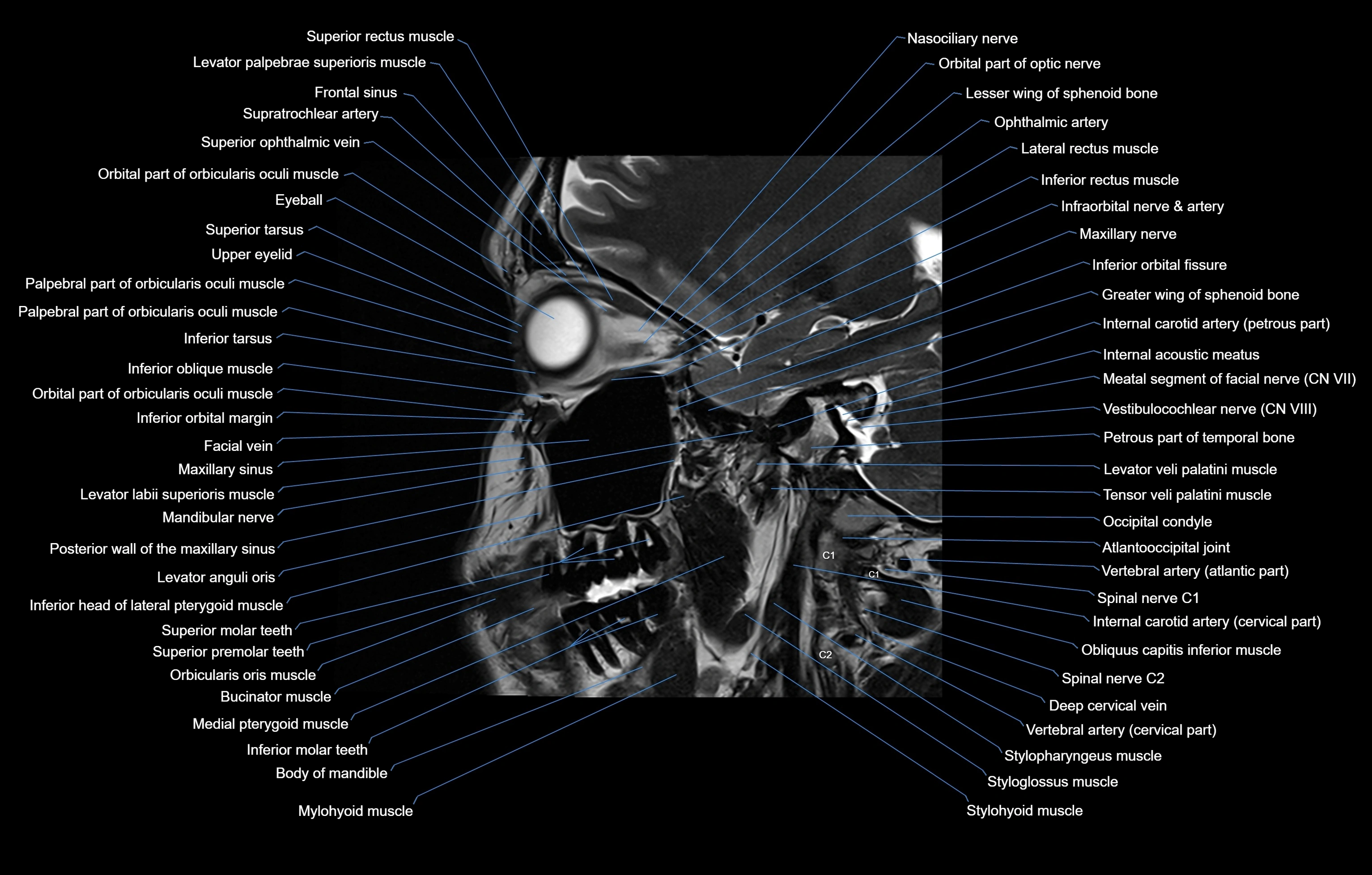 paranasal sinuses(PNS) MRI coronal  cross sectional anatomy 3T radiology  image-img-00001-00011.webp